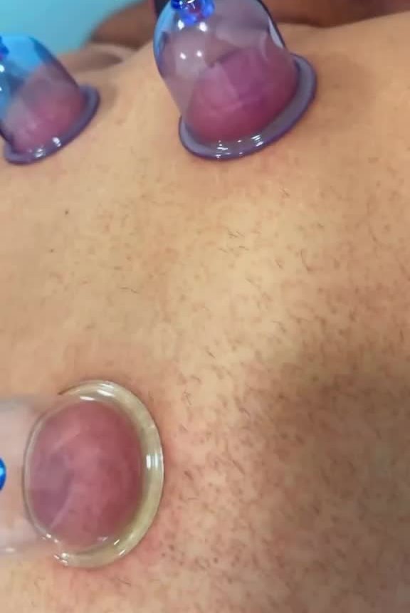 Cupping marks after a session