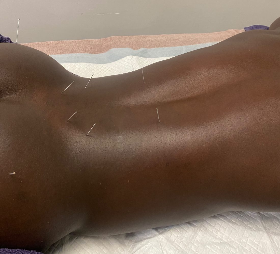 Acupuncture session on the back