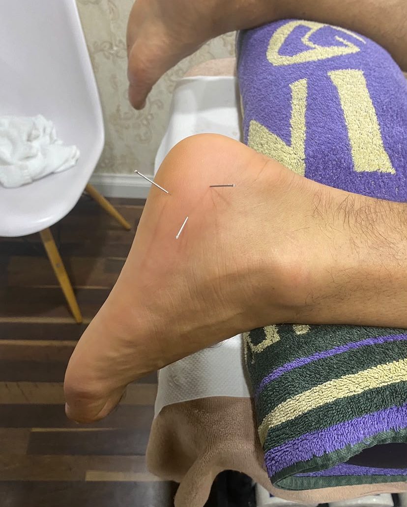 Acupuncture session on the ankle